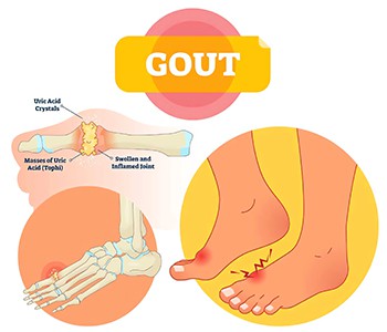 Drik øl og spis fisk og skaldyr, pas på gigt