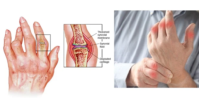 37Auranofin powder 37Auranofin powder